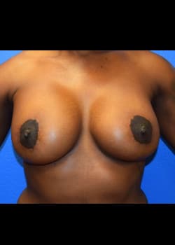 Breast Augmentation With Lift Patient # 4080