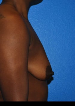 Breast Augmentation With Lift Patient # 4080