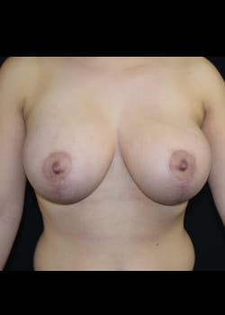 Breast Augmentation With Lift Patient # 4087