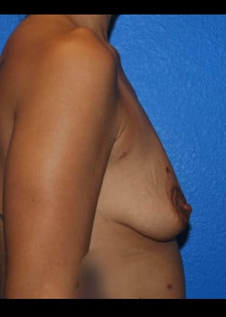Breast Augmentation With Lift Patient # 4142