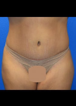 Tummy Tuck & Liposuction Patient # 4145
