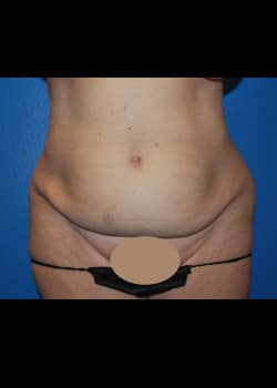 Tummy Tuck & Liposuction Patient # 4155