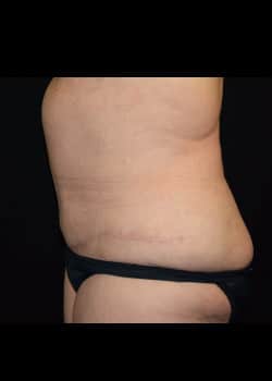 Tummy Tuck & Liposuction Patient # 4155