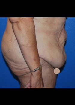 Tummy Tuck & Liposuction Patient # 4165