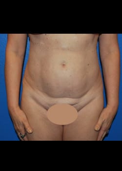 Tummy Tuck & Liposuction Patient # 4176