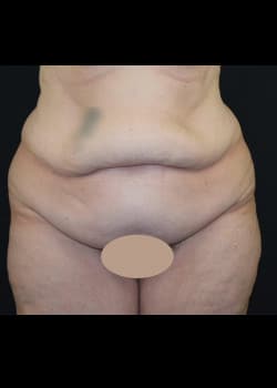 Tummy Tuck & Liposuction Patient # 4183