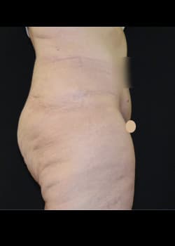Tummy Tuck & Liposuction Patient # 4183