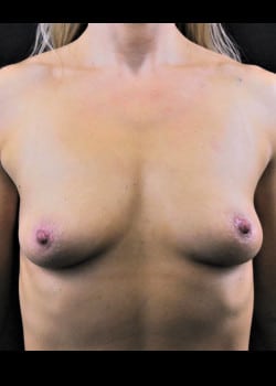 Breast Augmentation Patient # 4436