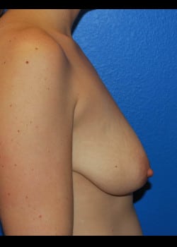 Breast Augmentation With Lift Patient # 4863