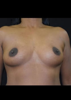 Breast Augmentation Patient # 4868