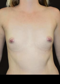 Breast Augmentation Patient # 4886