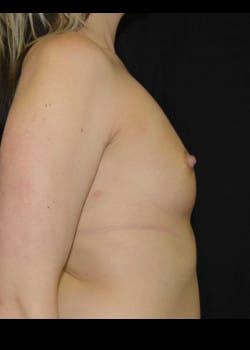 Breast Augmentation Patient # 4901