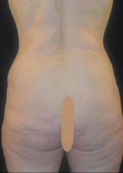 Tummy Tuck & Liposuction Patient # 4957
