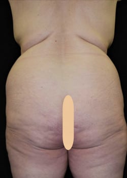 Tummy Tuck & Liposuction Patient # 4957