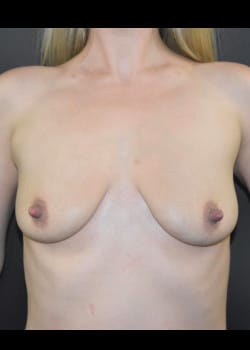 Breast Augmentation With Lift Patient # 4986